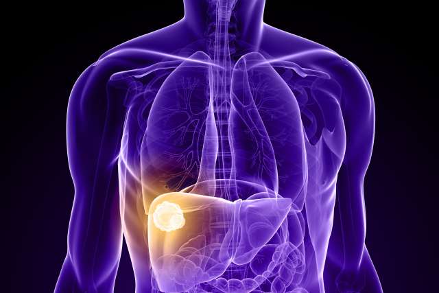 liver cancer